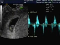 임신 6주 초음파 영상